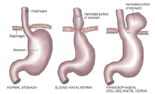 Strictures Dilation